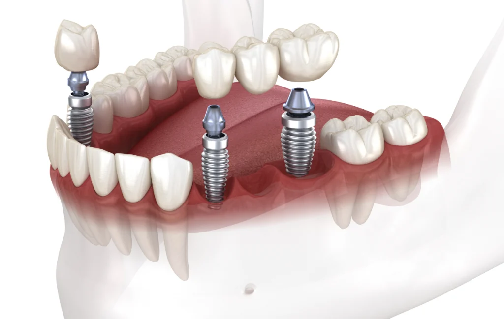 Implant unitaire Dentiste à Cagnes-sur-Mer | Dr Payam Gandjizadeh