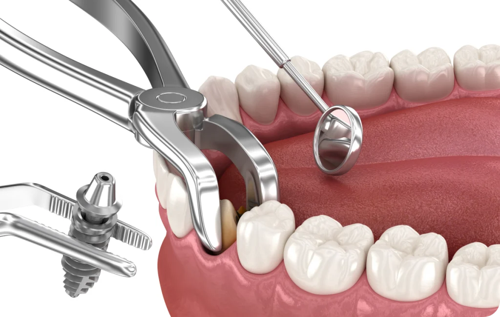 Extraction/implantation immédiate Dentiste à Cagnes-sur-Mer | Dr Payam Gandjizadeh