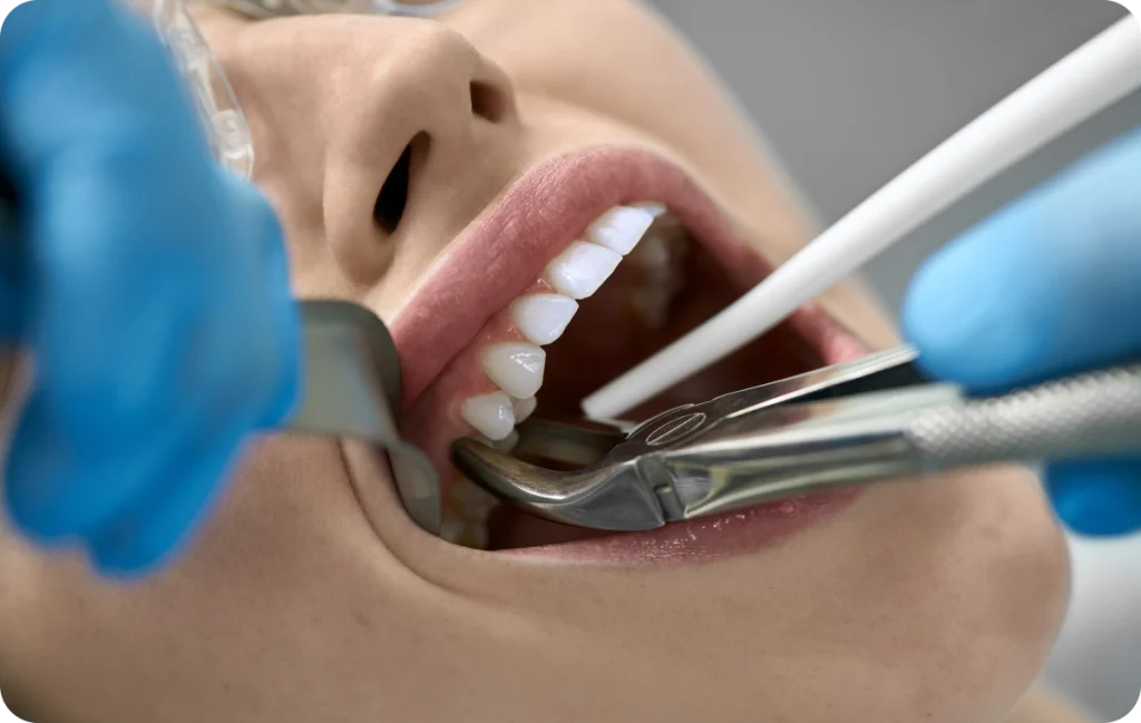Extraction/implantation immédiate Dentiste à Cagnes-sur-Mer | Dr Payam Gandjizadeh