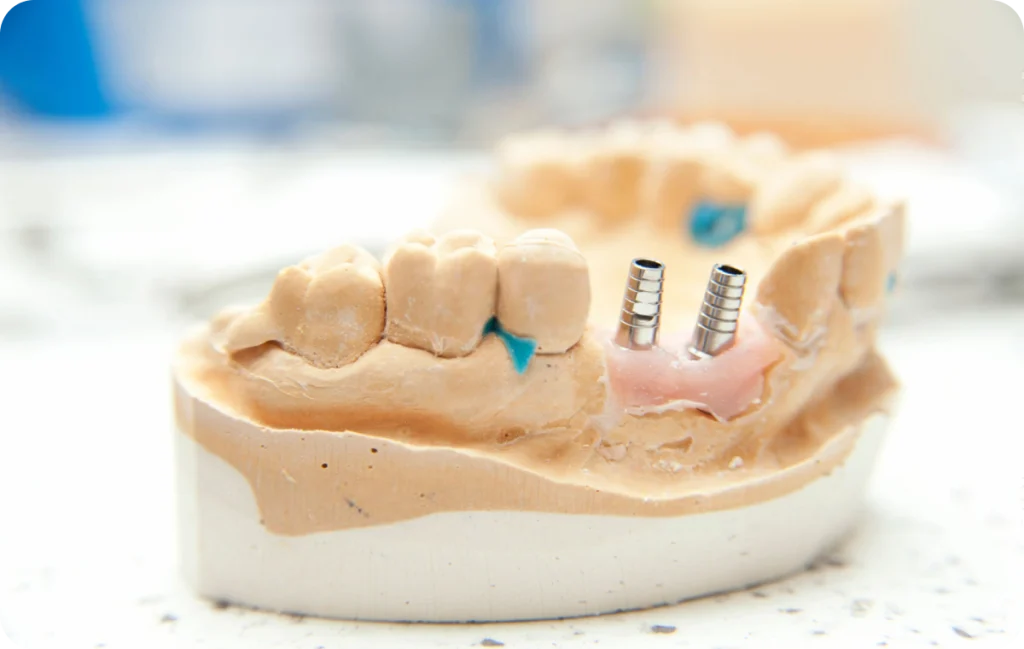 Extraction/implantation immédiate Dentiste à Cagnes-sur-Mer | Dr Payam Gandjizadeh