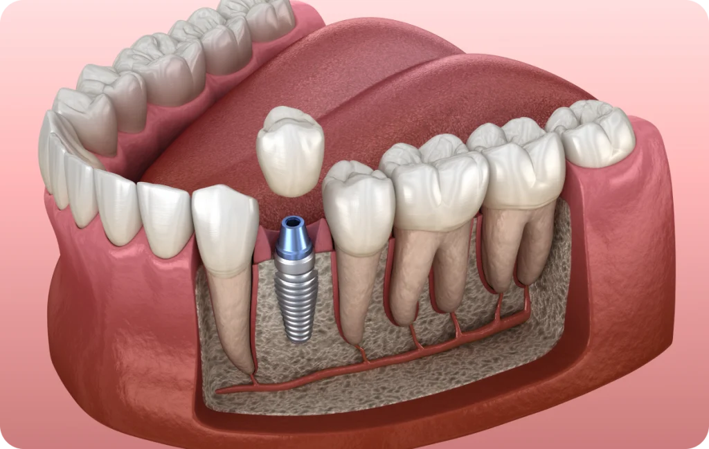 Implant unitaire Dentiste à Cagnes-sur-Mer | Dr Payam Gandjizadeh