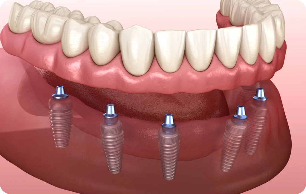 implant dentaire cagnes sur mer solution All-on-4 / All-on-6 Dentiste à Cagnes-sur-Mer | Dr Payam Gandjizadeh