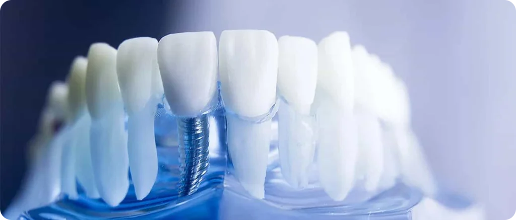 Implant unitaire Dentiste à Cagnes-sur-Mer | Dr Payam Gandjizadeh