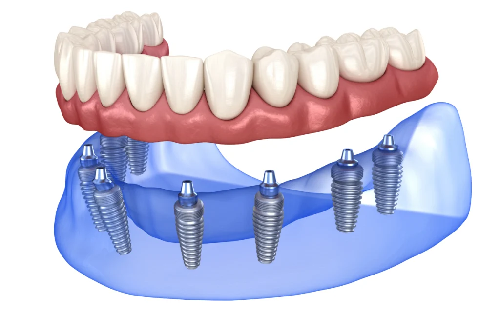 prothese sur implants all on cagnes sur mer resultat All-on-4 / All-on-6 Dentiste à Cagnes-sur-Mer | Dr Payam Gandjizadeh