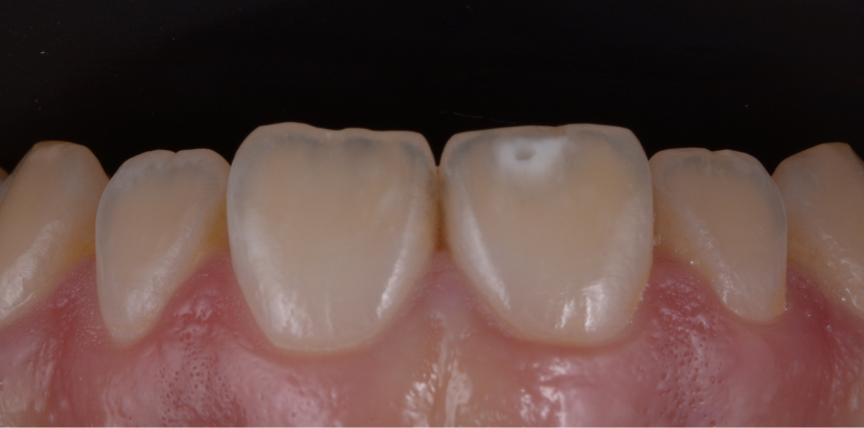 Cas cliniques Dentistes à Cagnes-sur-Mer, Drs Payam & Pegah Gandjidadeh