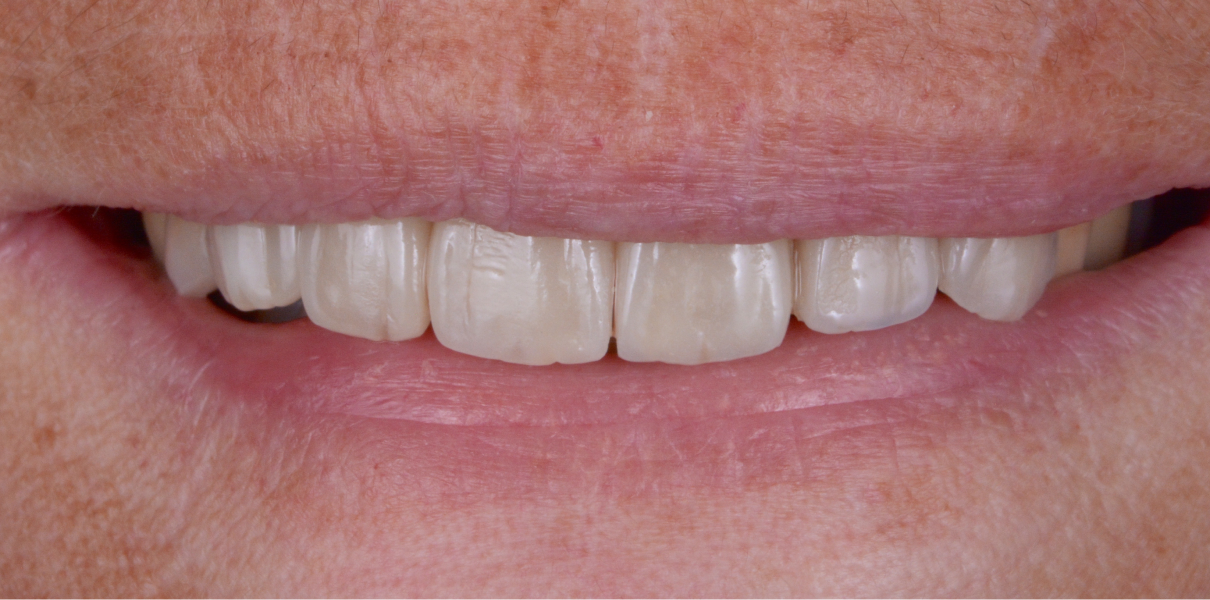 Cas cliniques Dentistes à Cagnes-sur-Mer, Drs Payam & Pegah Gandjidadeh