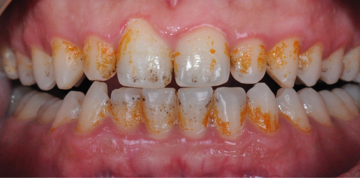 Cas cliniques Dentistes à Cagnes-sur-Mer, Drs Payam & Pegah Gandjidadeh