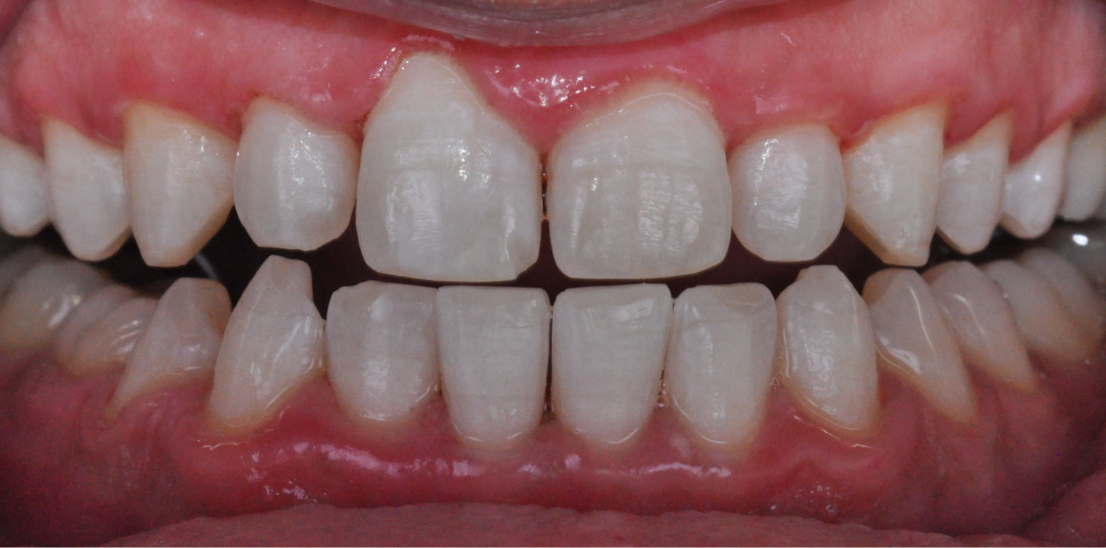 Cas cliniques Dentistes à Cagnes-sur-Mer, Drs Payam & Pegah Gandjidadeh