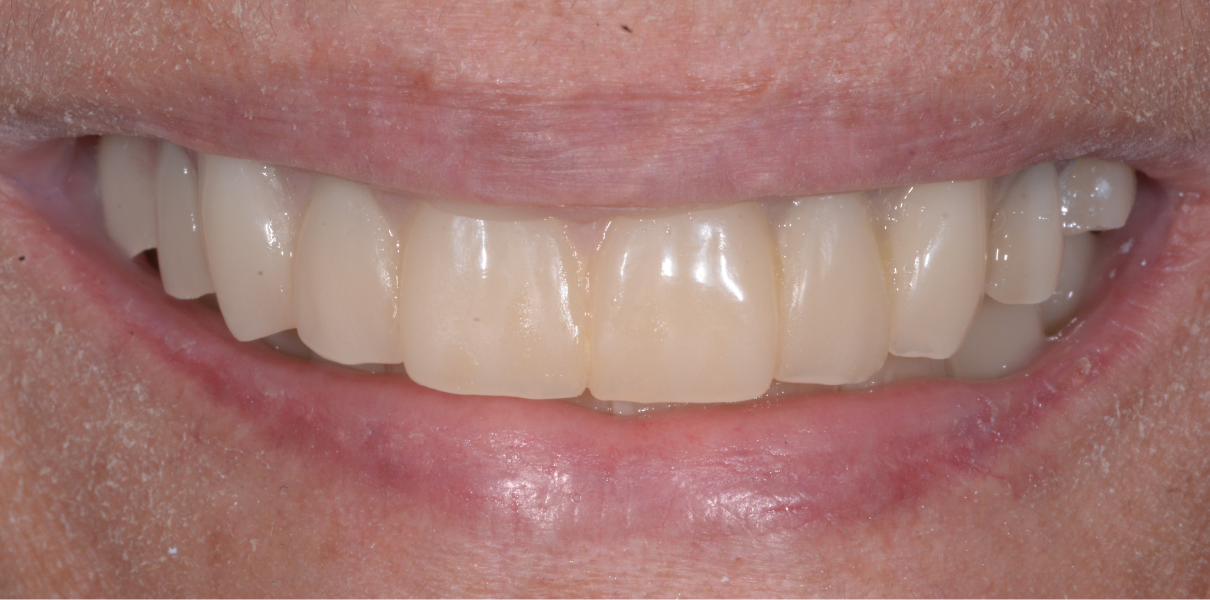 Cas cliniques Dentistes à Cagnes-sur-Mer, Drs Payam & Pegah Gandjidadeh