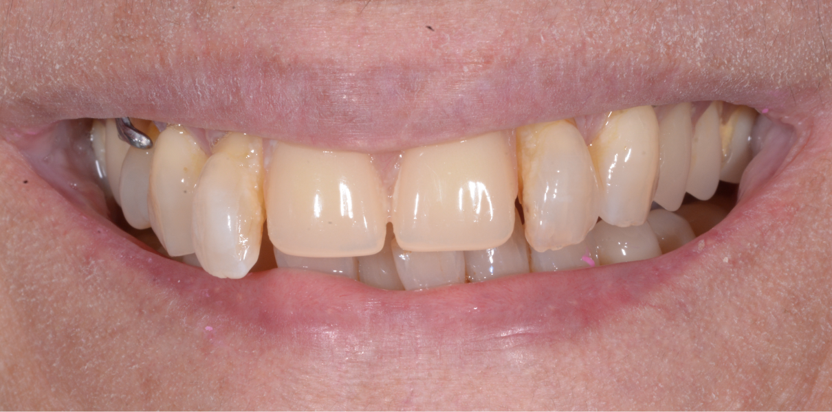 Cas cliniques Dentistes à Cagnes-sur-Mer, Drs Payam & Pegah Gandjidadeh