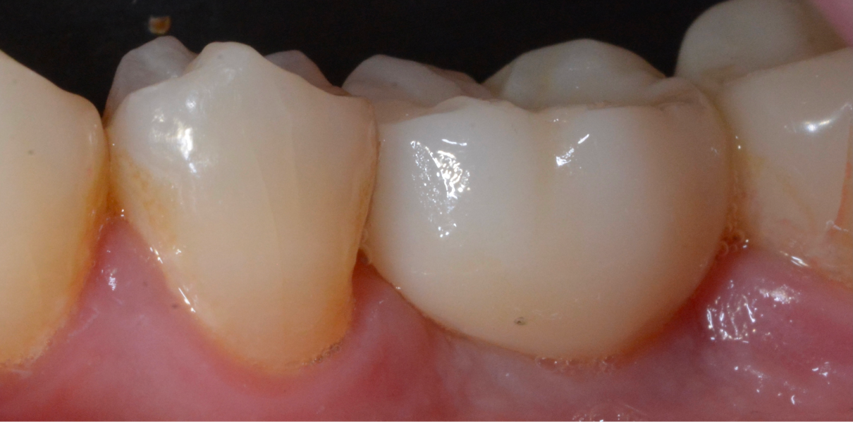 Cas cliniques Dentistes à Cagnes-sur-Mer, Drs Payam & Pegah Gandjidadeh