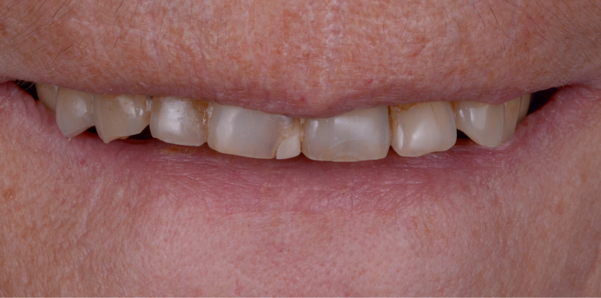 Cas cliniques Dentistes à Cagnes-sur-Mer, Drs Payam & Pegah Gandjidadeh
