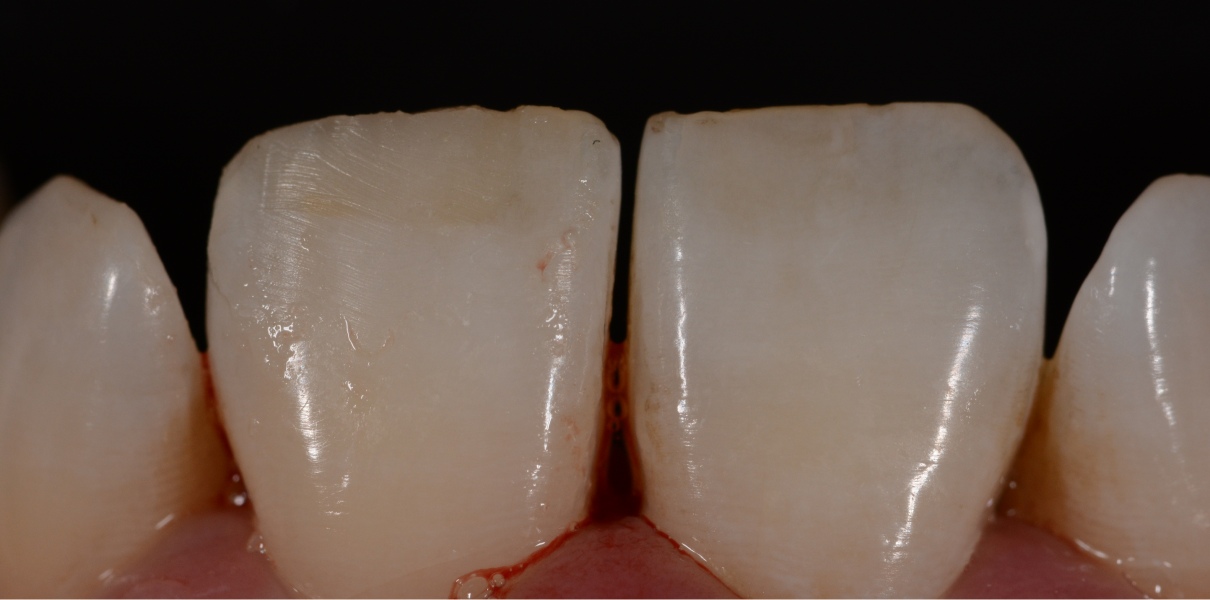 Cas cliniques Dentistes à Cagnes-sur-Mer, Drs Payam & Pegah Gandjidadeh