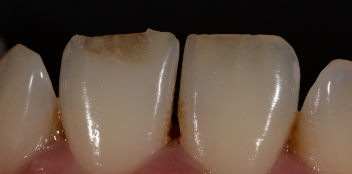 Cas cliniques Dentistes à Cagnes-sur-Mer, Drs Payam & Pegah Gandjidadeh