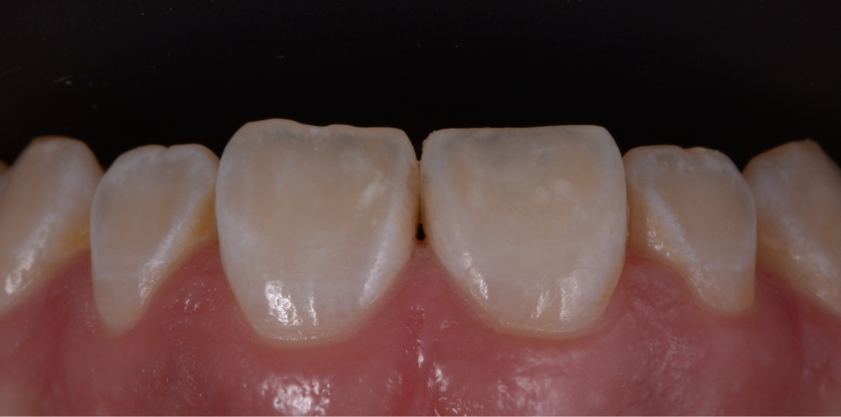 Cas cliniques Dentistes à Cagnes-sur-Mer, Drs Payam & Pegah Gandjidadeh