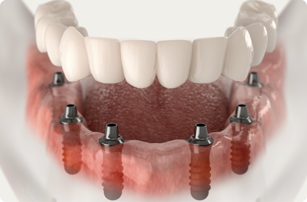 Vos besoins Dentistes à Cagnes-sur-Mer, Drs Payam & Pegah Gandjidadeh