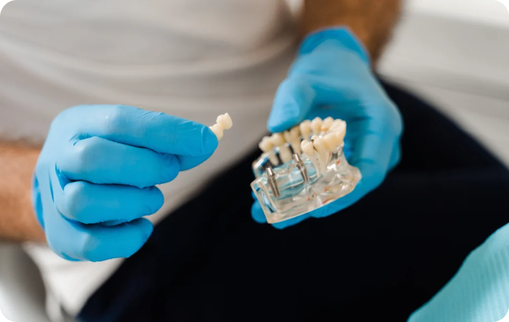 Couronnes et bridges sur implant Dentiste à Cagnes-sur-Mer | Dr Payam Gandjizadeh