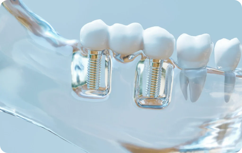 Couronnes et bridges sur implant Dentiste à Cagnes-sur-Mer | Dr Payam Gandjizadeh