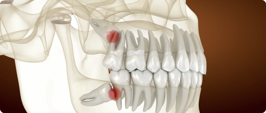Dents de sagesse