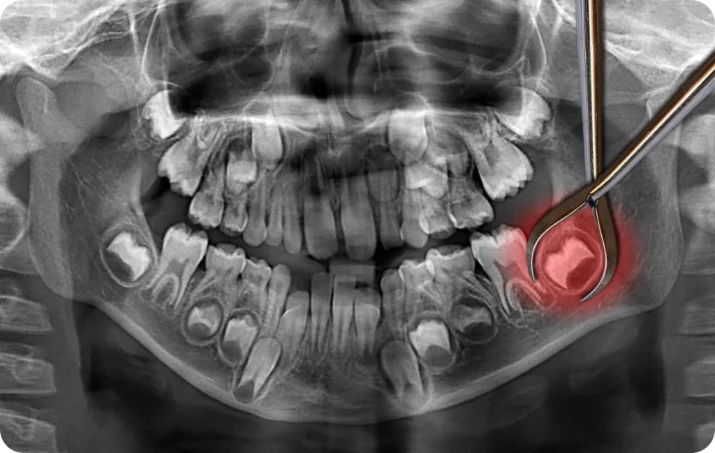 Dents de sagesse Dentiste à Cagnes-sur-Mer | Dr Payam Gandjizadeh