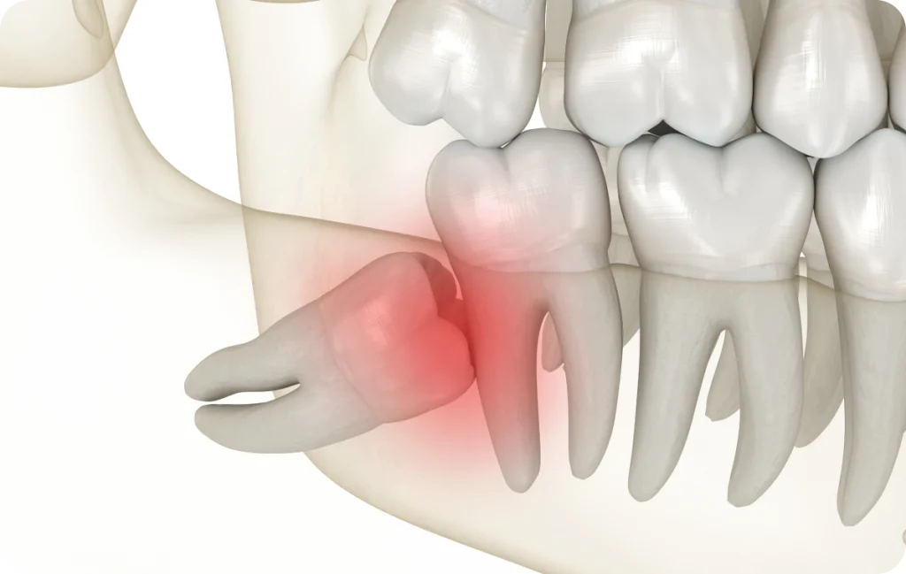 Dents de sagesse Dentiste à Cagnes-sur-Mer | Dr Payam Gandjizadeh