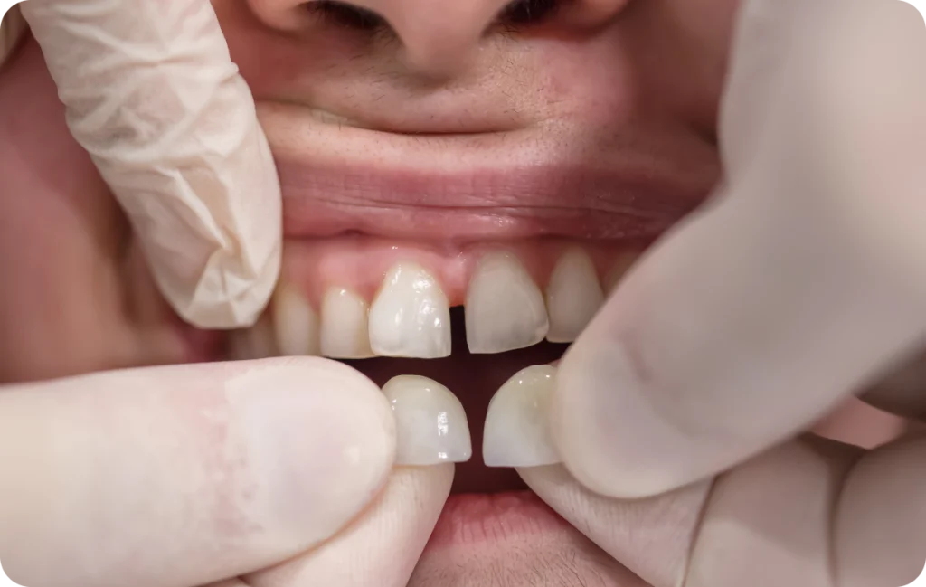Facette dentaire Dentiste à Cagnes-sur-Mer | Dr Payam Gandjizadeh