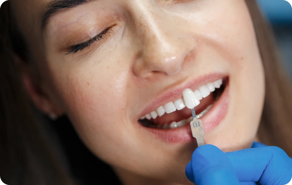 Facette dentaire Dentiste à Cagnes-sur-Mer | Dr Payam Gandjizadeh