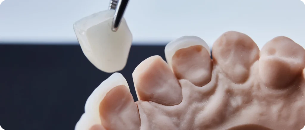 Facette dentaire Dentiste à Cagnes-sur-Mer | Dr Payam Gandjizadeh