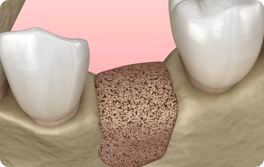 greffe osseuse cagnes sur mer implant Greffe osseuse Dentiste à Cagnes-sur-Mer | Dr Payam Gandjizadeh