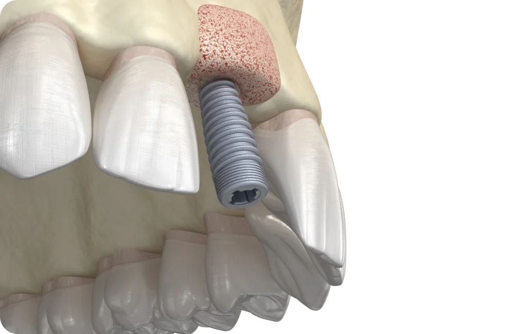 greffe osseuse cagnes sur mer solution Greffe osseuse Dentiste à Cagnes-sur-Mer | Dr Payam Gandjizadeh