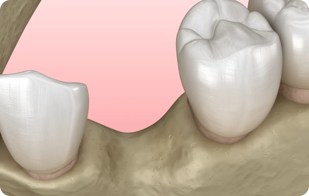 greffe osseuse cagnes sur mer volume Greffe osseuse Dentiste à Cagnes-sur-Mer | Dr Payam Gandjizadeh