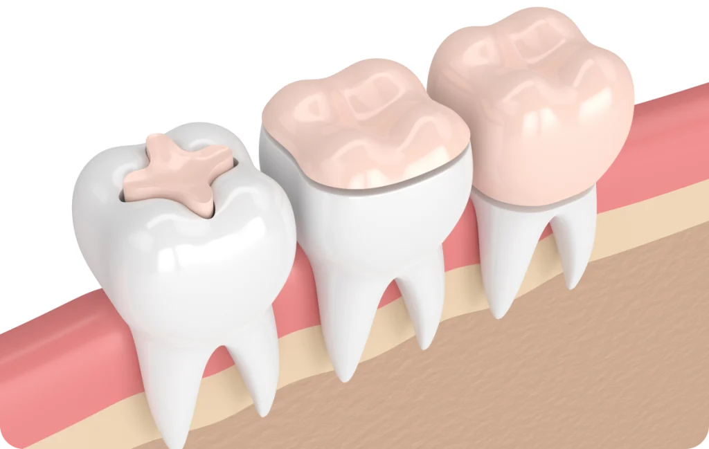 Inlay / Onlay Dentiste à Cagnes-sur-Mer | Dr Payam Gandjizadeh