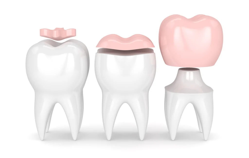 Inlay / Onlay Dentiste à Cagnes-sur-Mer | Dr Payam Gandjizadeh