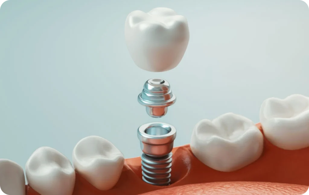 Mise en charge immédiate Dentiste à Cagnes-sur-Mer | Dr Payam Gandjizadeh