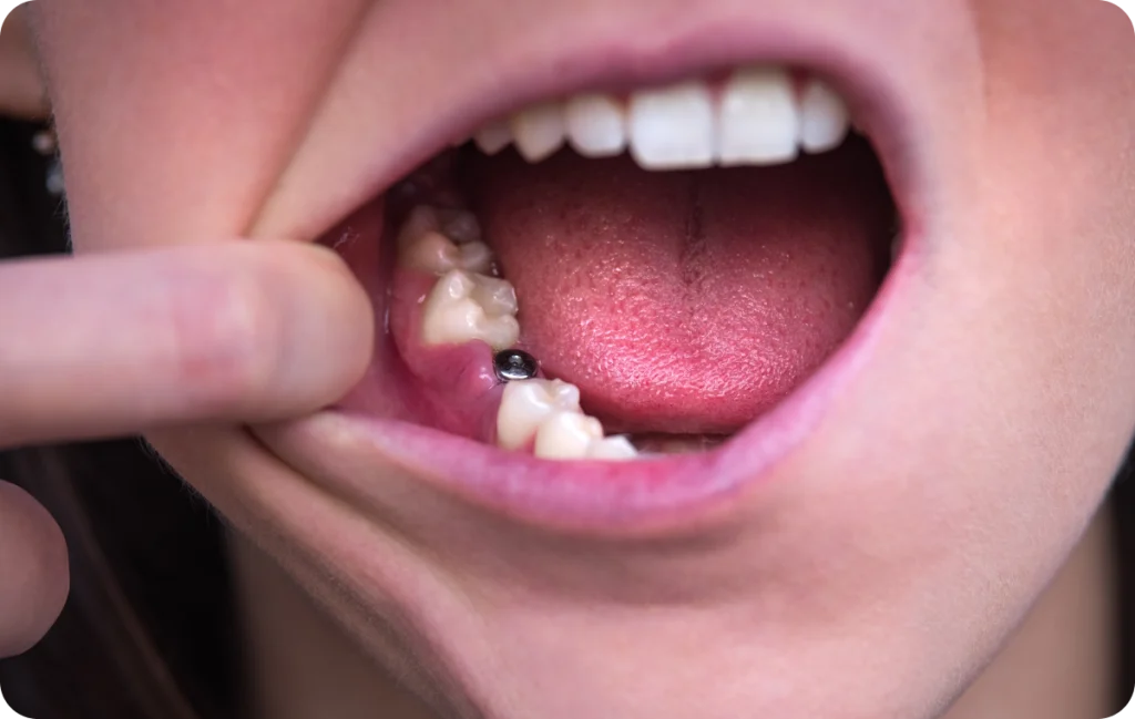 Mise en charge immédiate Dentiste à Cagnes-sur-Mer | Dr Payam Gandjizadeh