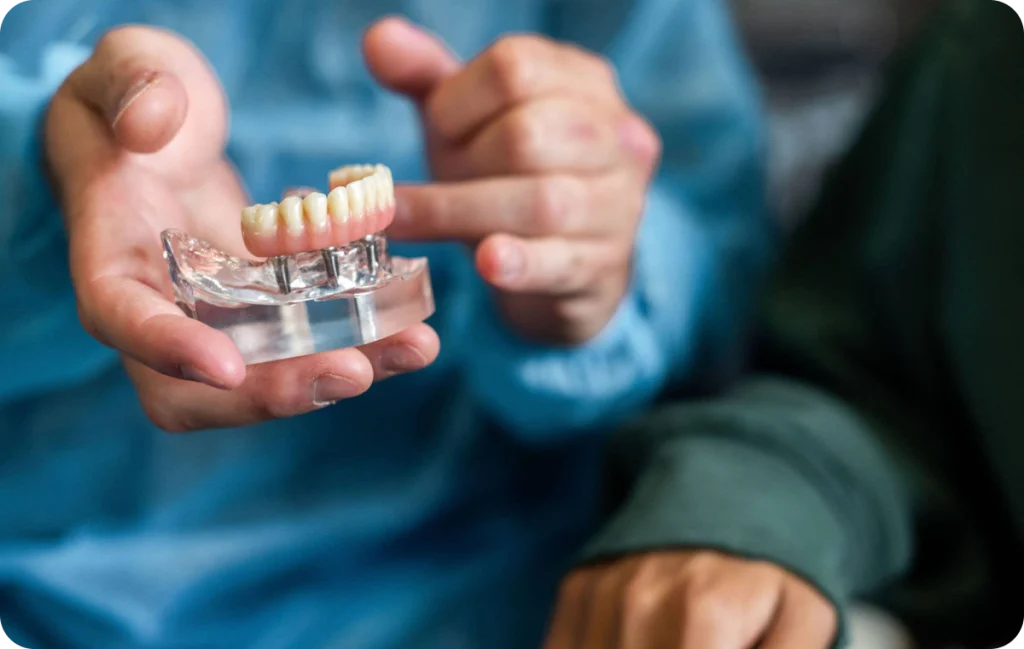 prothese amovible implant cagnes sur mer confort Prothèse amovible sur implant Dentiste à Cagnes-sur-Mer | Dr Payam Gandjizadeh