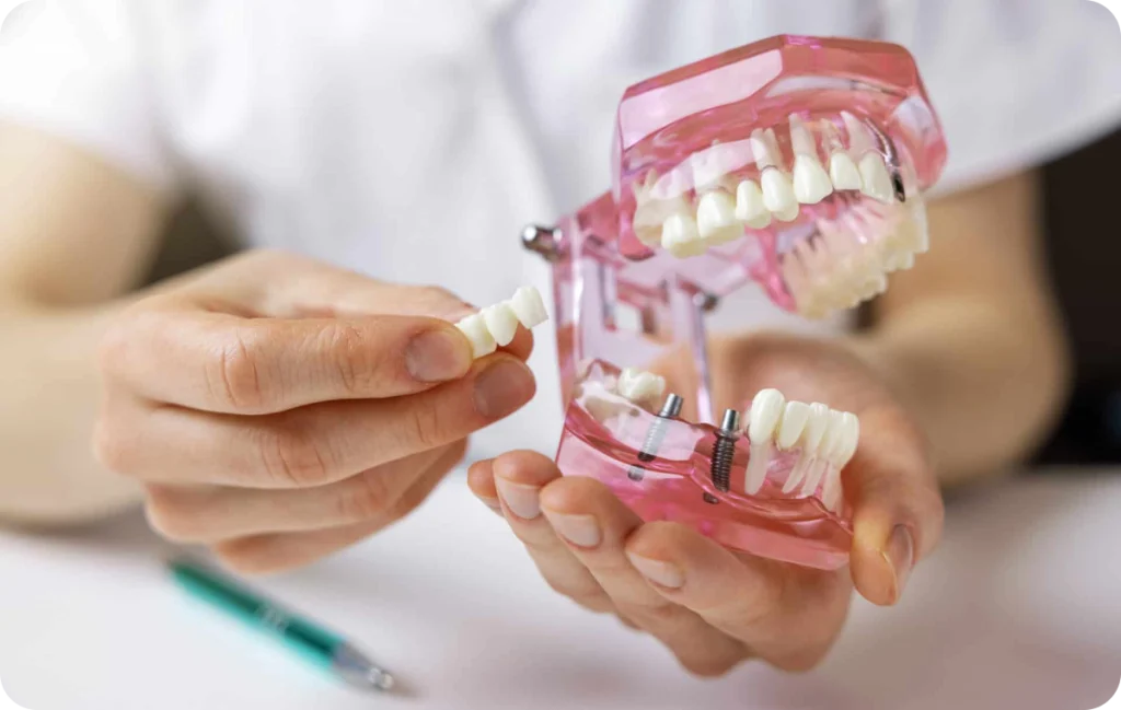 prothese amovible implant cagnes sur mer fixation Prothèse amovible sur implant Dentiste à Cagnes-sur-Mer | Dr Payam Gandjizadeh