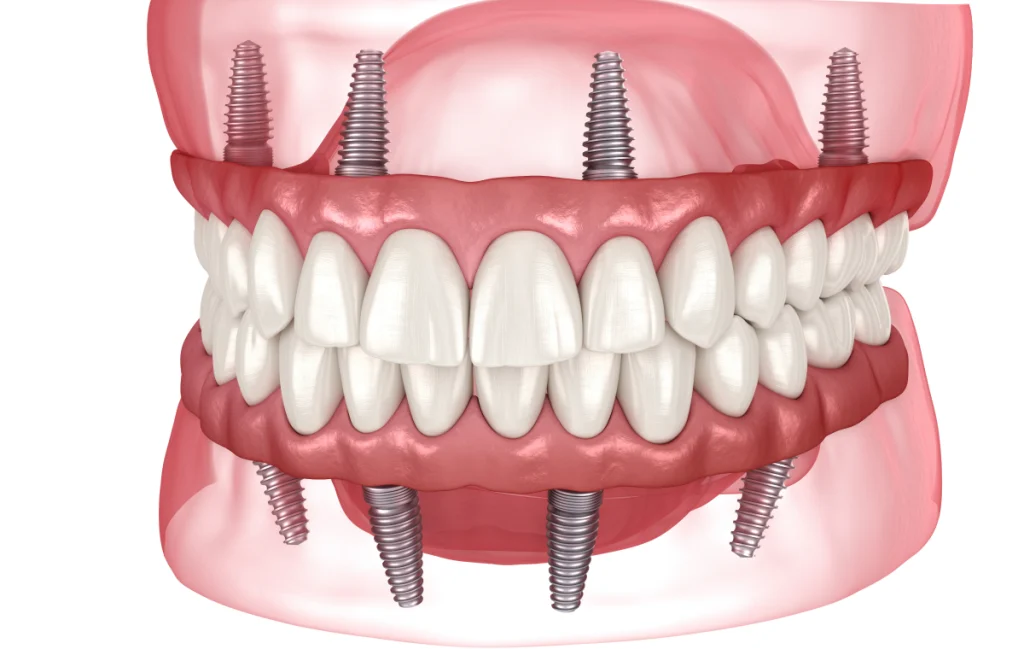 prothese amovible implant cagnes sur mer solution Prothèse amovible sur implant Dentiste à Cagnes-sur-Mer | Dr Payam Gandjizadeh