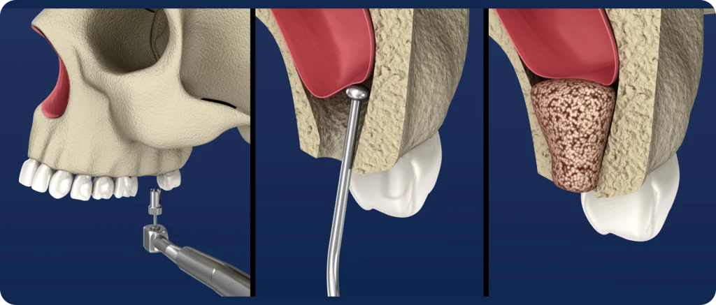 sinus lift cagnes sur mer implant Sinus lift Dentiste à Cagnes-sur-Mer | Dr Payam Gandjizadeh