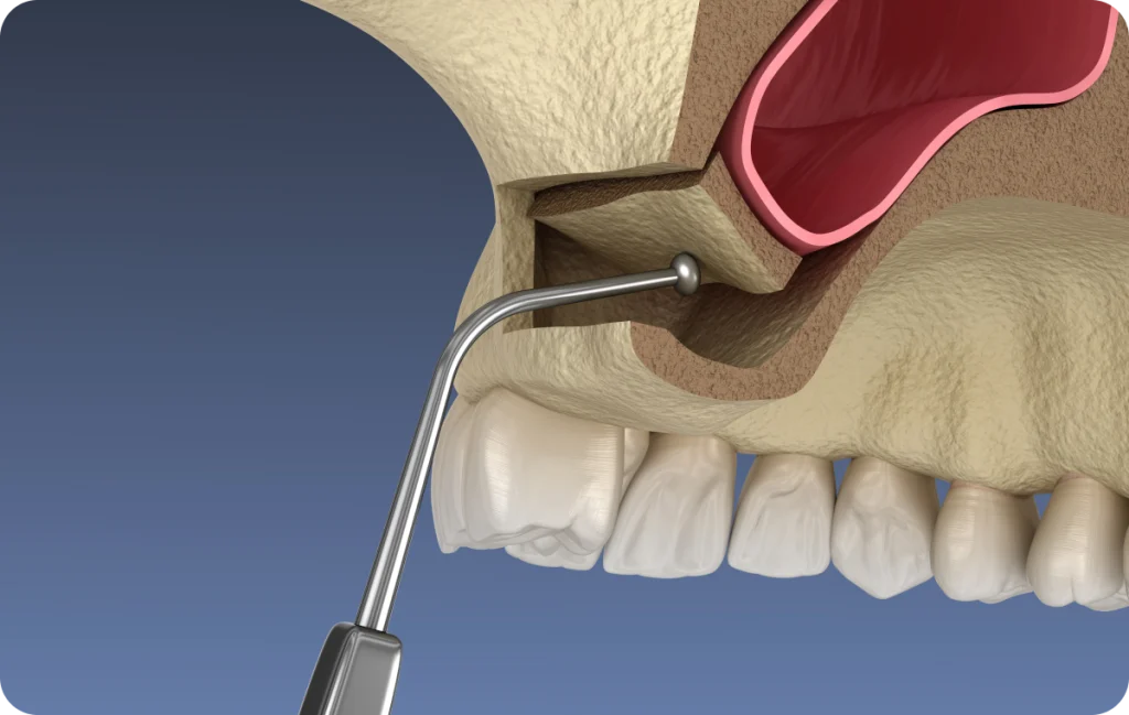sinus lift cagnes sur mer osseuse Sinus lift Dentiste à Cagnes-sur-Mer | Dr Payam Gandjizadeh