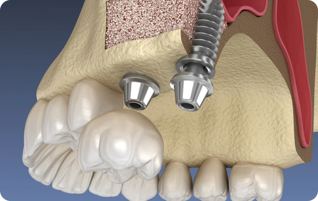 sinus lift cagnes sur mer technique Sinus lift Dentiste à Cagnes-sur-Mer | Dr Payam Gandjizadeh