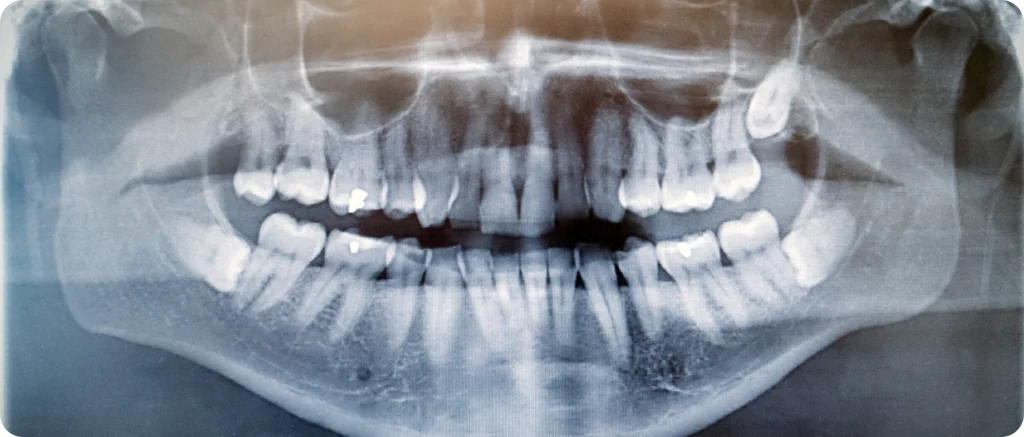Implant dentaire à Vence Dentiste à Cagnes-sur-Mer | Dr Payam Gandjizadeh